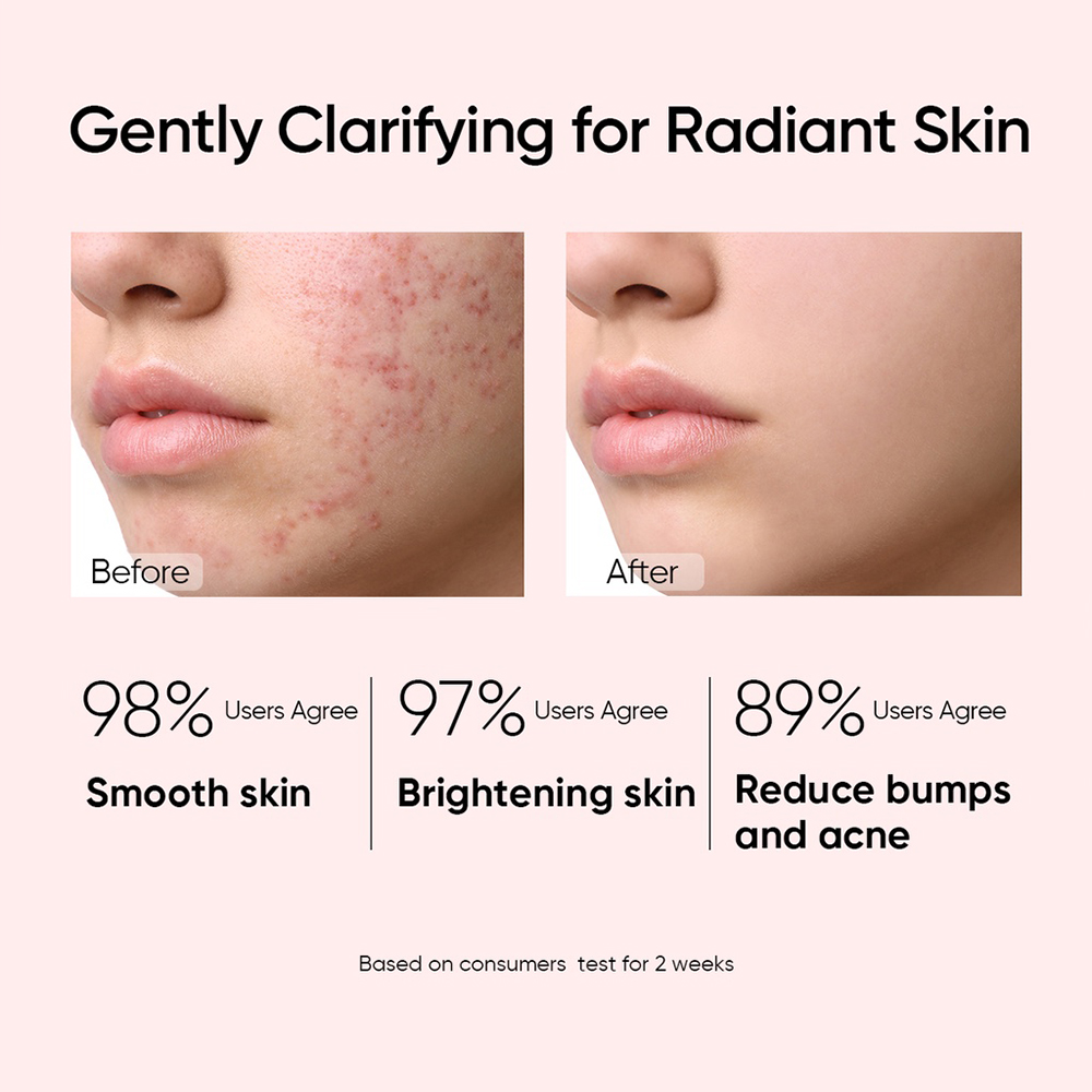 Hot Selling Organic Facial Hydrating Anti Acne Toner