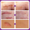 Customize Logo Acne And Dark Spot And Scar Removal Cream Stretch Mark Cream