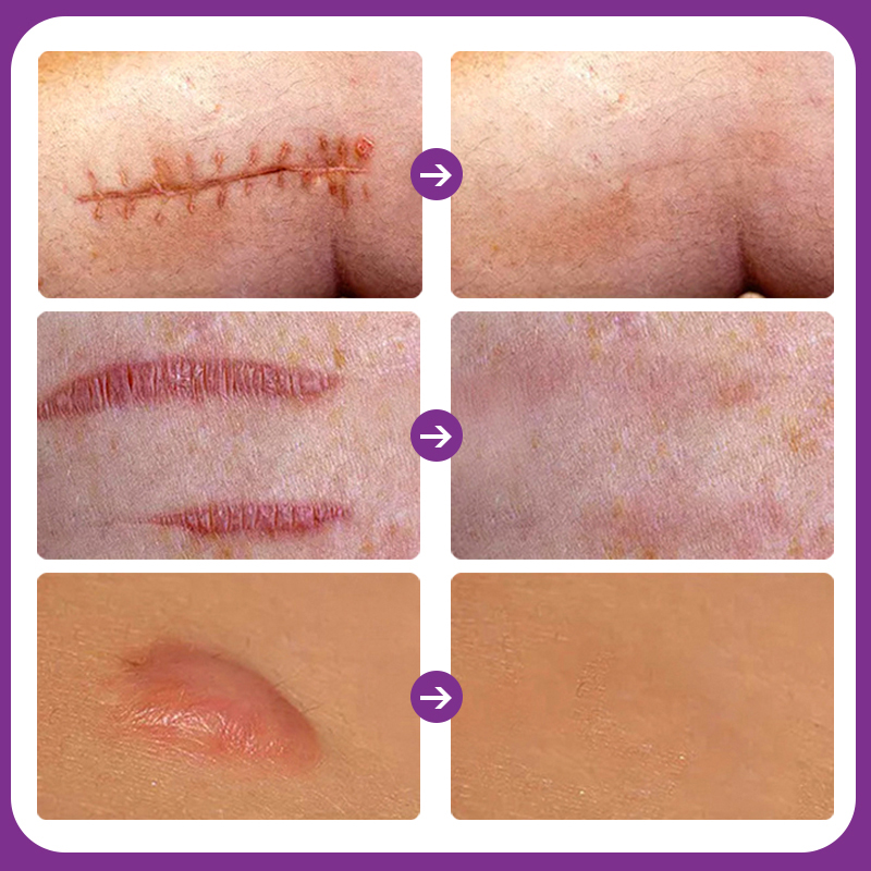Customize Logo Acne And Dark Spot And Scar Removal Cream Stretch Mark Cream